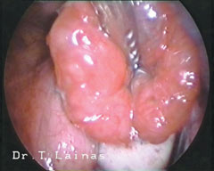 Final salpingostomy result after laser laparoscopic surgery. 